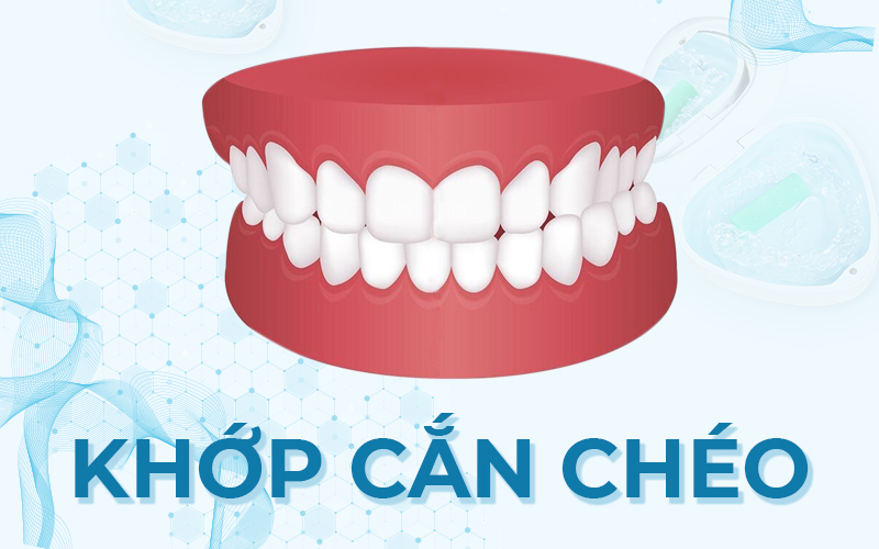 Khớp cắn chéo là gì? Đặc điểm, Cách điều trị? - LeeTray